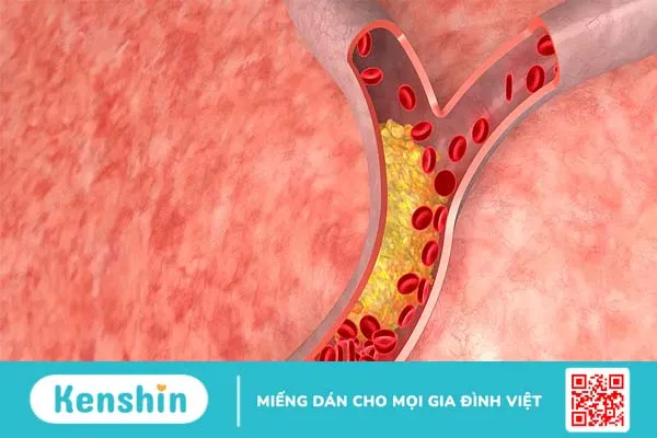 4 cách giảm mỡ máu cao để phòng ngừa tai biến