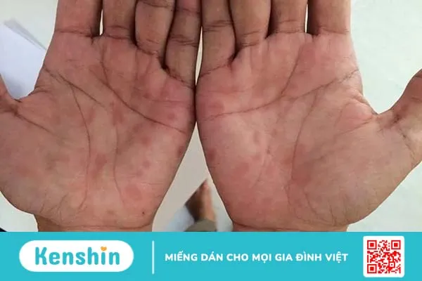 4 giai đoạn bệnh giang mai và dấu hiệu cụ thể