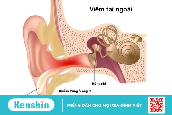 7 cách chữa viêm tai ngoài tại nhà hay và dễ áp dụng, bạn đã thử chưa?