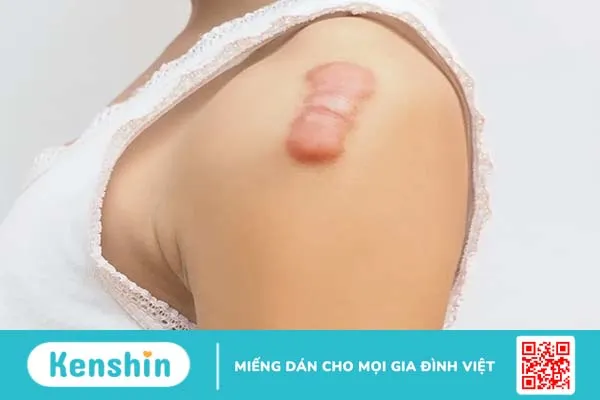 Ăn thịt gà có bị sẹo lồi không? Giải đáp từ góc nhìn khoa học