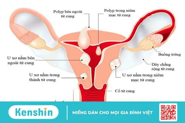 Ảnh hưởng của u xơ tử cung đối với phụ nữ trước và trong thai kỳ ra sao?