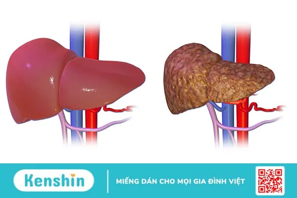 Bạn đã biết người mắc bệnh gan kiêng ăn gì chưa?