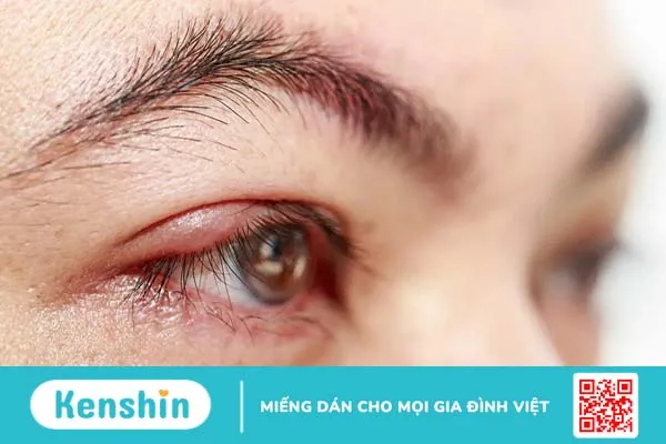 Bệnh đau mắt hột có tự khỏi không?