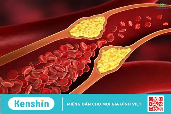 Bệnh máu nhiễm mỡ có nguy hiểm không?