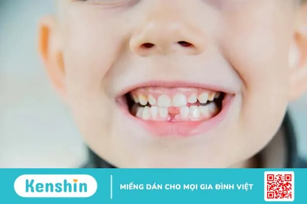 Bố mẹ chăm sóc bé vừa nhổ răng xong như thế nào?