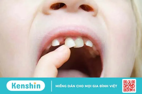 Bố mẹ chăm sóc bé vừa nhổ răng xong như thế nào?