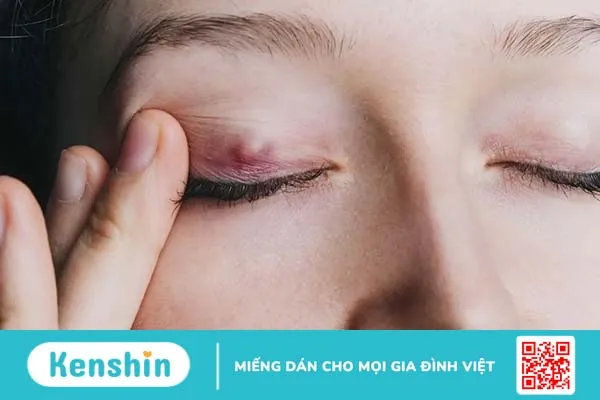 Chắp mắt là gì? Bị chắp mắt bao lâu thì khỏi và cách điều trị