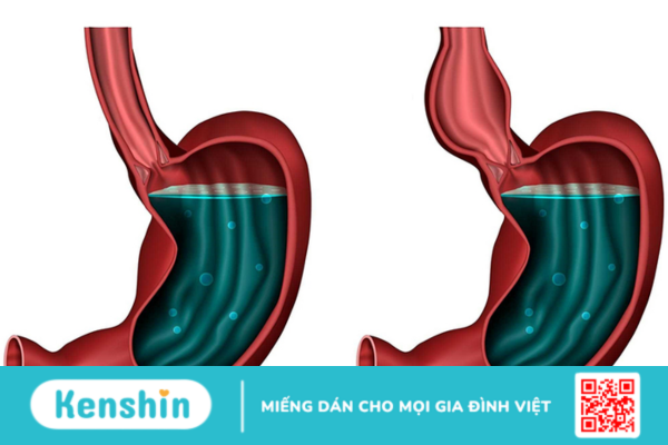 Các phương pháp điều trị co thắt tâm vị