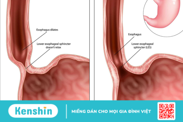 Các phương pháp điều trị co thắt tâm vị