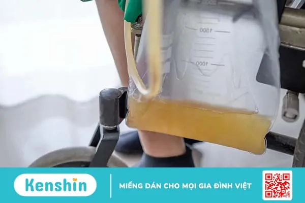 Dẫn lưu bàng quang trên xương mu là gì? Quy trình thực hiện và những lưu ý