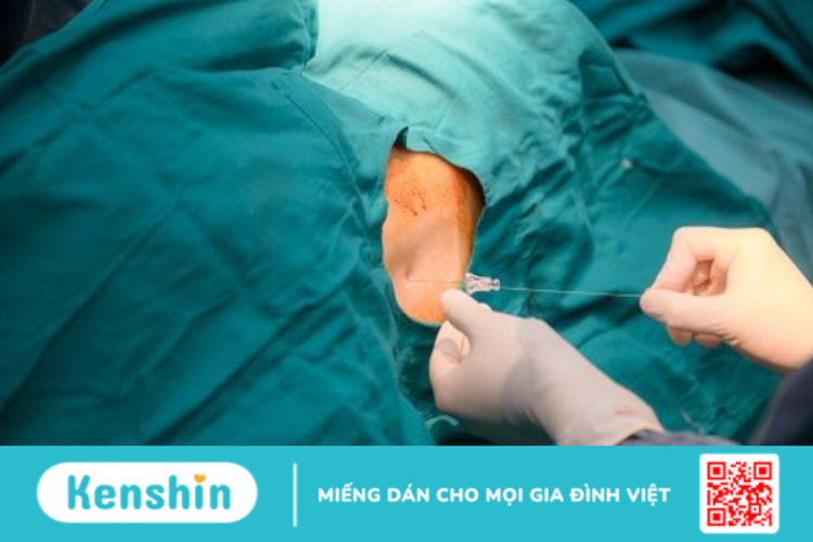 Gây mê liệu có ảnh hưởng đến thai nhi và quá trình sinh nở?