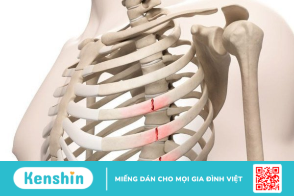 Những dấu hiệu và triệu chứng của tình trạng gãy xương sườn?