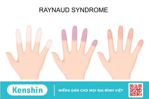 Hiện tượng Raynaud