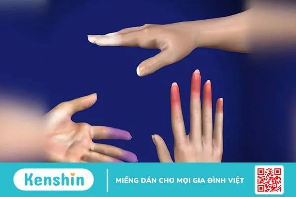 Hiện tượng Raynaud