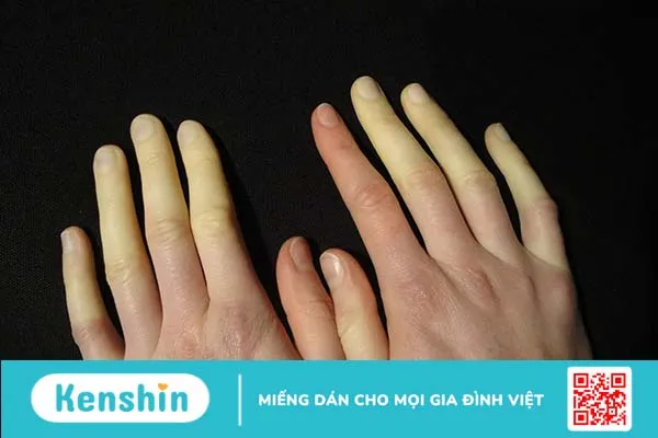 Hiện tượng Raynaud