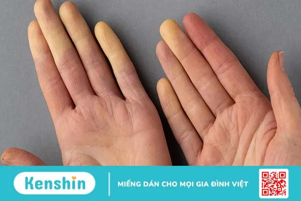 Hiện tượng Raynaud