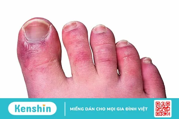 Hiện tượng Raynaud