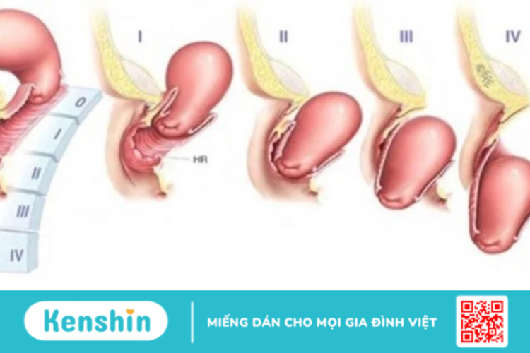 Hỏi đáp Bác sĩ: Bị sa tử cung có mang thai được không?