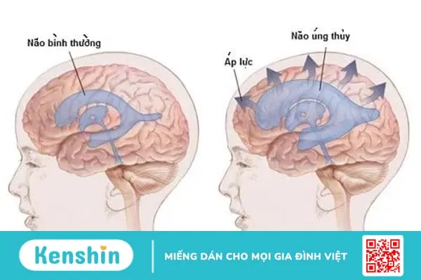 Não úng thủy ở trẻ sơ sinh: nguyên nhân, dấu hiệu và cách điều trị