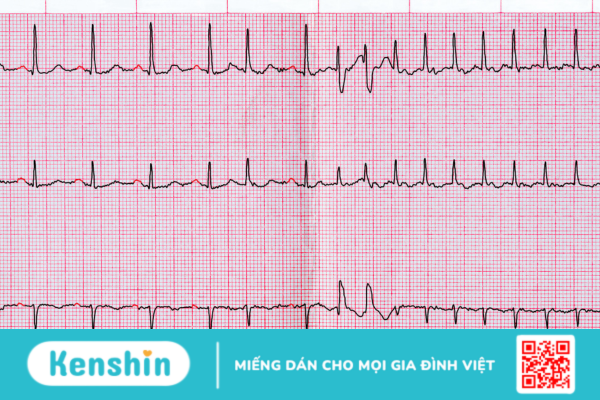 Ngoại tâm thu nhĩ là bệnh lý gì? Có nguy hiểm không?