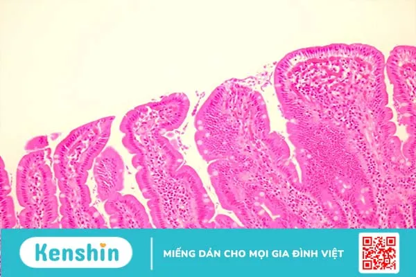 Nhiễm Giardia (nhiễm trùng ruột non do Giardia)