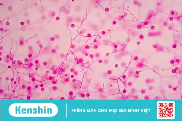 Nhiễm nấm Histoplasma (vi nấm Histoplasma)