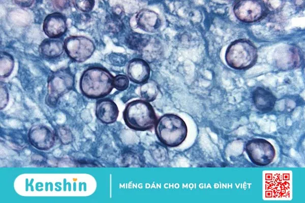 Nhiễm nấm Histoplasma (vi nấm Histoplasma)