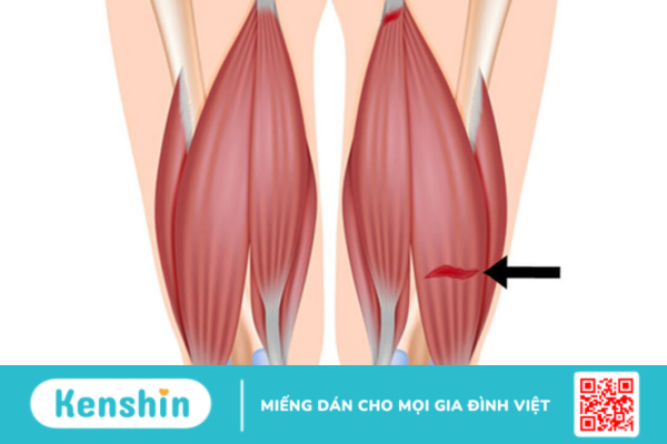 Rách cơ và những dấu hiệu không nên xem nhẹ