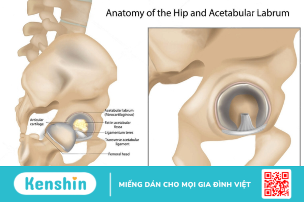 Rách sụn viền ổ cối