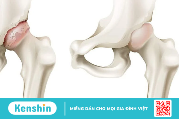 Rách sụn viền ổ cối