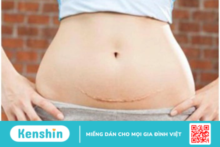 Sinh mổ lần 4 được không? Mẹ cần lưu ý những gì để tránh rủi ro?