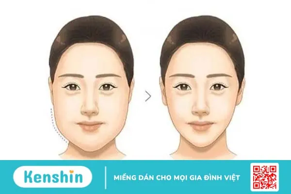 Tất tần tật thông tin về phương pháp tiêm tan mỡ má