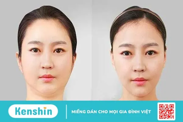 Tất tần tật thông tin về phương pháp tiêm tan mỡ má