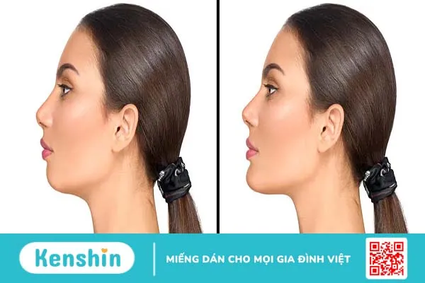 Tiêm filler cằm có ảnh hưởng gì không? – Những điều cần biết