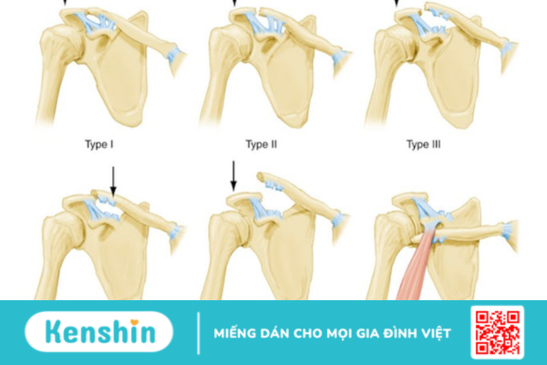 Phương pháp điều trị trật khớp cùng đòn hiệu quả