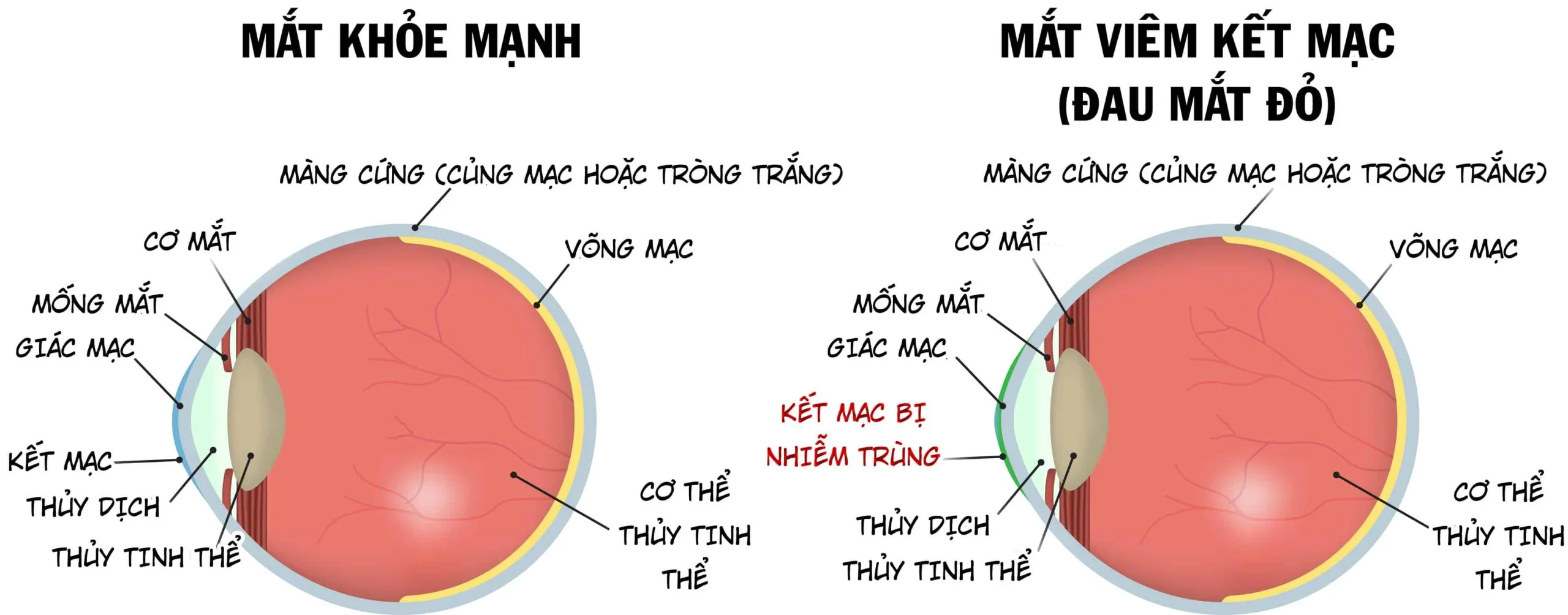 Viêm bờ mi