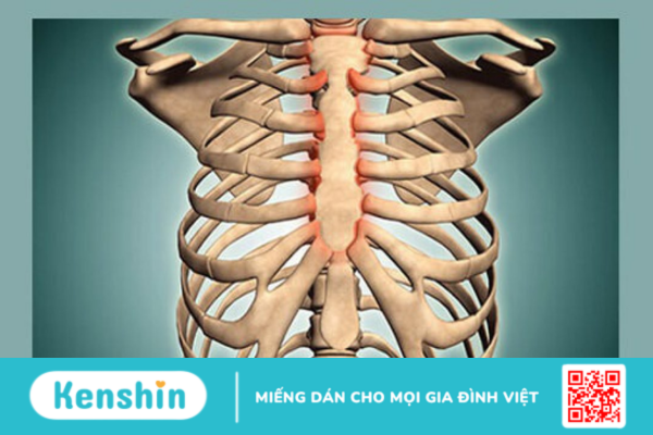 Viêm sụn sườn và những điều người bệnh cần biết!