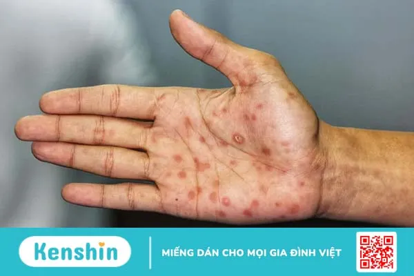 Xét nghiệm giang mai là cách phát hiện bệnh giang mai nhanh nhất